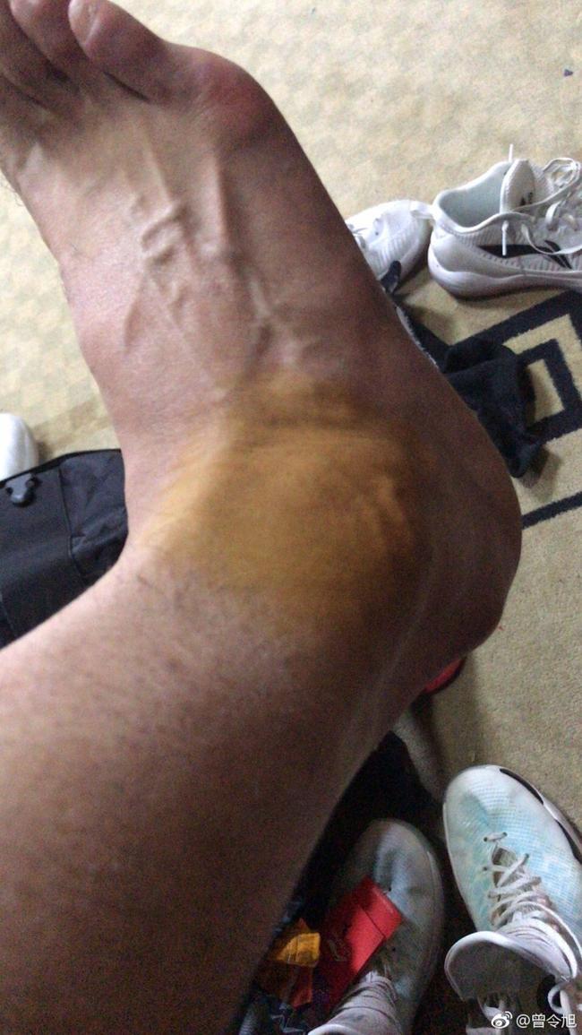 曾令旭晒脚伤照片:不想为输球找借口 讨厌伤病