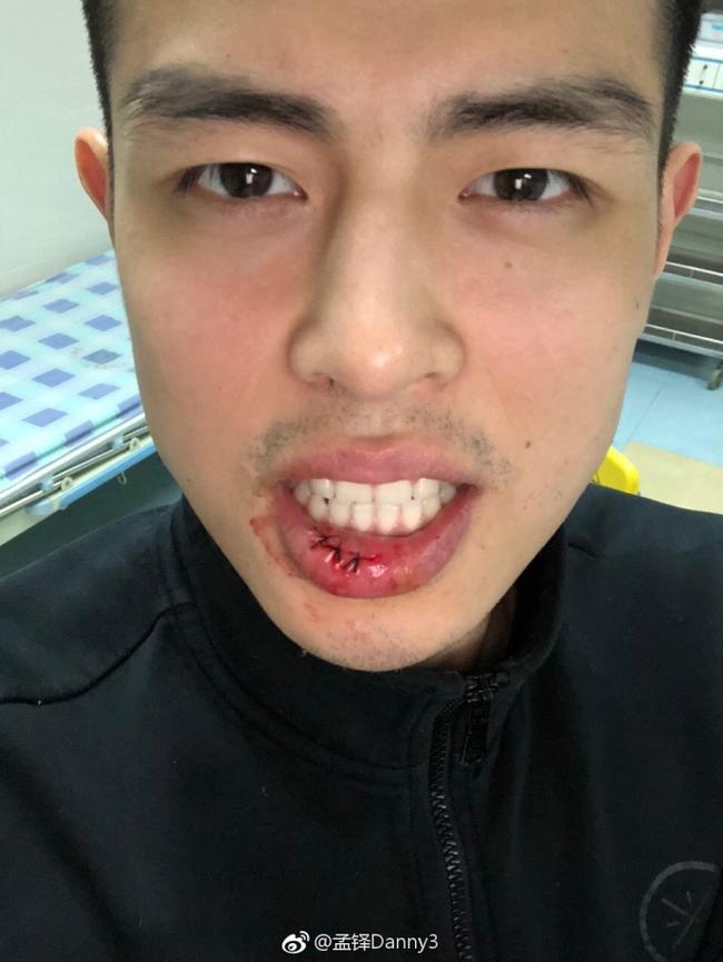 孟铎晒方硕嘴唇伤口照片心疼硕宝宝一百秒