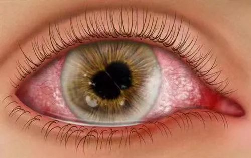 葡萄膜炎是一种常见顽固性眼病,由感染,免疫,外伤等多种原因引起眼内