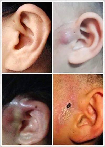 您家宝宝耳朵边有这种神秘的小孔吗 小孔大麻烦 快去对照检查 手机新浪网 您家宝宝耳朵边有这种神秘的小孔吗 小孔大麻烦 快去对照检查 手机新浪网