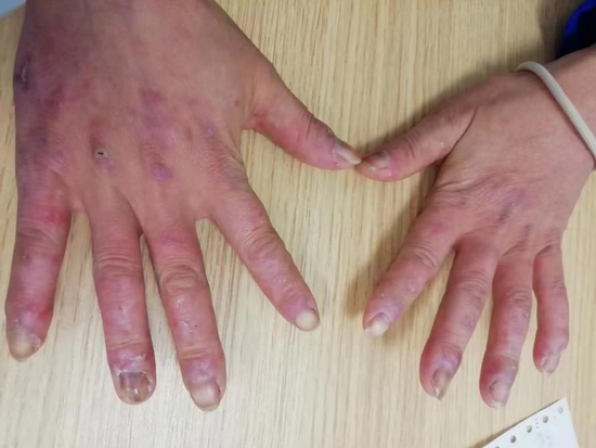 【西安市第五医院专病门诊推介】系统性红斑狼疮专病门诊——中西并举