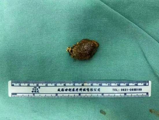 切除的胆囊结石