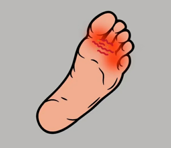 西安市第五医院科普:防范脚上的传染病——脚癣