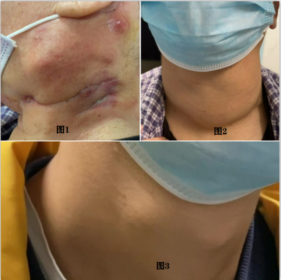 其实除了影响美观,脖子的包从医学角度来看可能是一些健康的隐患.