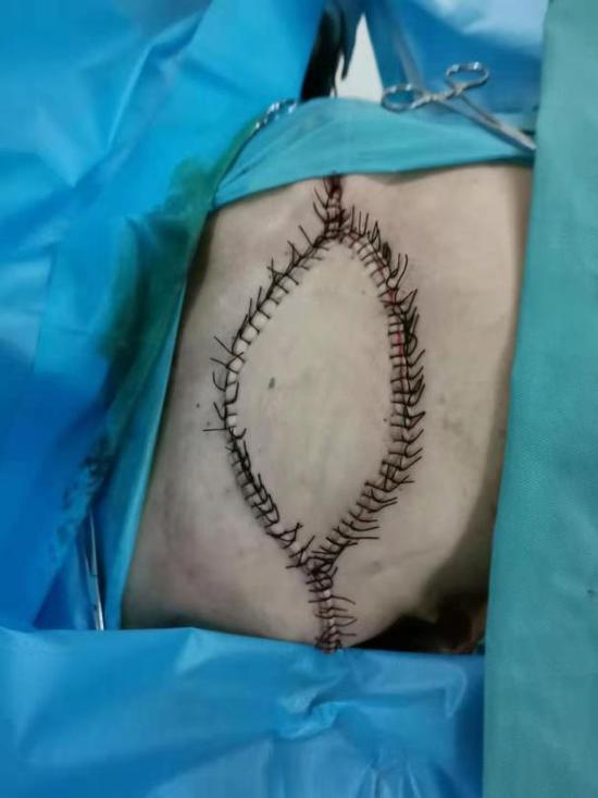 西安交大一附院东院区乳腺外科顺利切除首例罕见乳腺巨大肿瘤