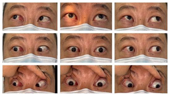 图2&nbsp;术后9眼位