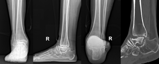 患者脚踝术前x线及ct