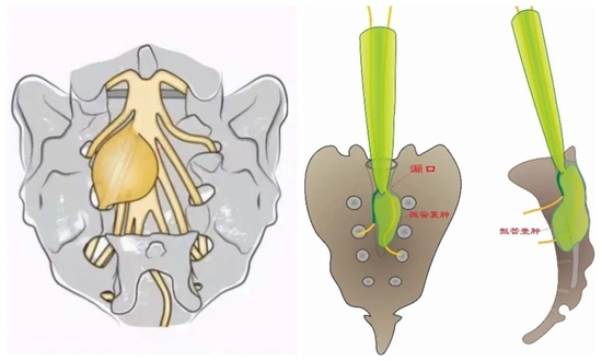 女性骶管囊肿图片图片