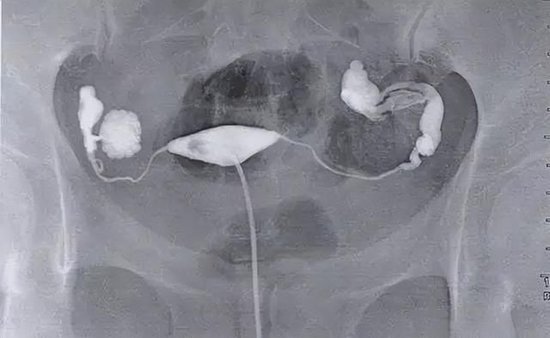 输卵管间质部梗阻图片