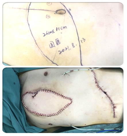 手术缝合后患者原先变形凸起的胸廓平复如故