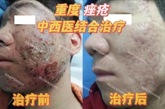 [西安高新医院皮肤科治愈患者图]