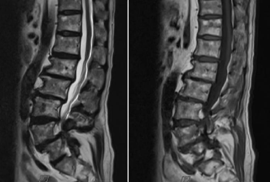 图1。术前腰椎X线片和MRI