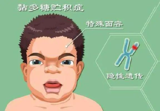 黏多糖贮积症II型