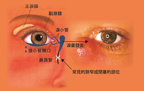 急性泪囊炎多由慢性泪囊炎引发.