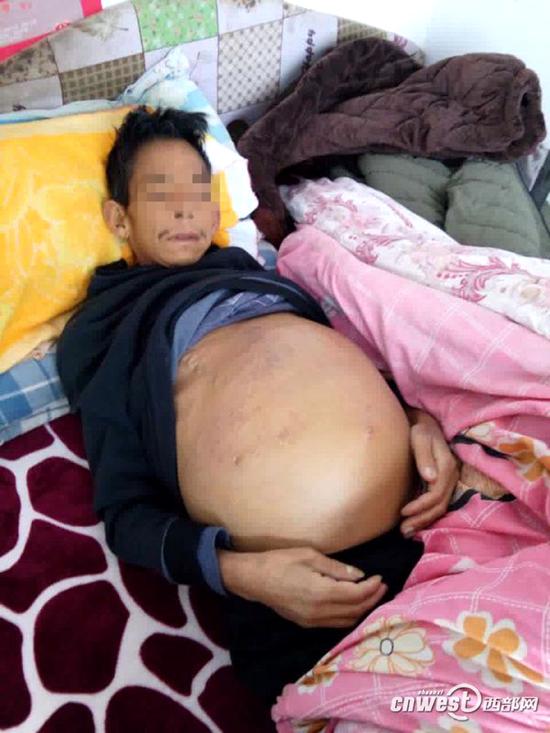 商洛孝子10年不离病榻父亲肝硬化四处借钱治病