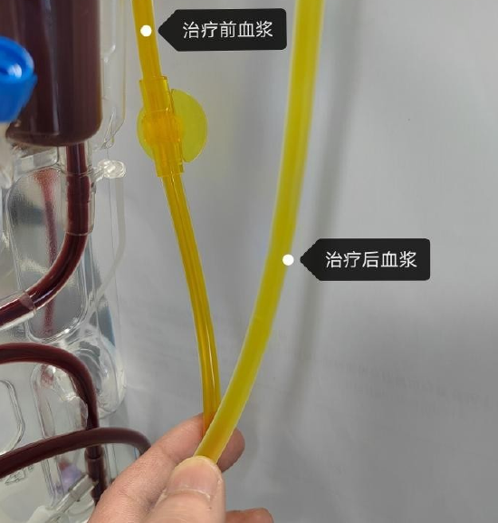 西安市红会医院重症医学科利用人工肝技术救治危重患者_新浪陕西_新浪