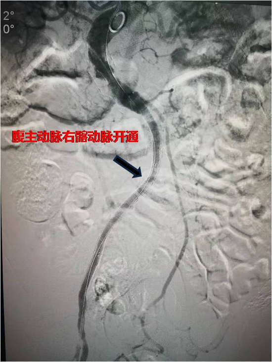 此次,超高龄复杂主髂动脉闭塞患者的成功救治,标志着西安交大一附在