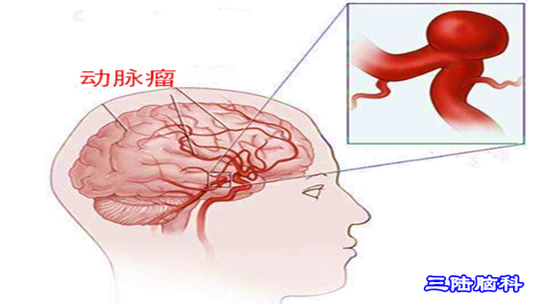 三陆脑科谈脑病|颅内动脉瘤被称为"不定时炸弹",可要警惕了!