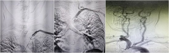 （支架顺利植入左锁骨下动脉开口处，造影提示左侧椎动脉正向血流恢复）