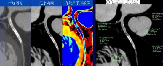为您"画心"溯源心痛——冠状动脉cta检查