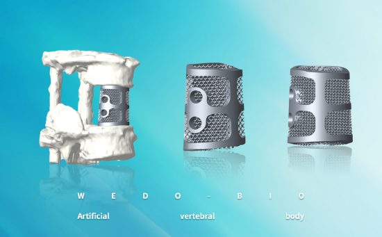l1单节段人工椎体模拟植入效果图
