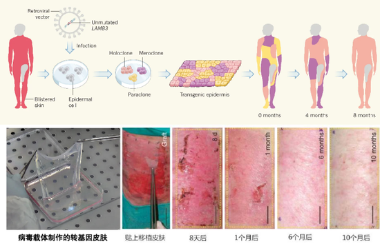 图16。病毒载体制作转基因皮肤治疗交界型大疱性表皮松解症[3]