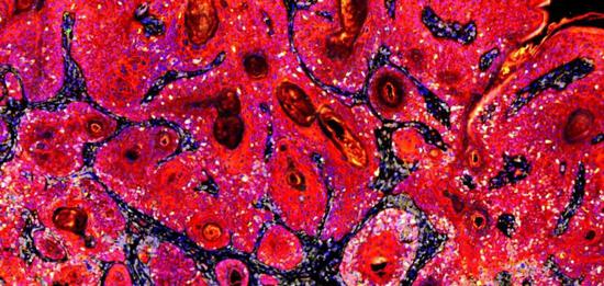 ▲感染了共生HPV的癌细胞（红色）受到免疫细胞（灰色和黄色）的攻击（图片来源：Jon Messerschmidt）