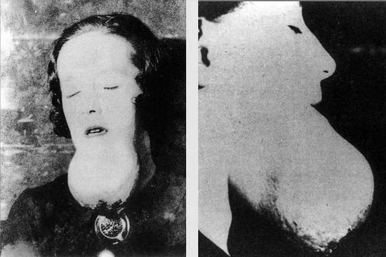 四乙基铅:这位孤独先知能查明每种毒物仍无法阻止美国人作死 这位镭姑娘的下巴长了巨大的肿瘤