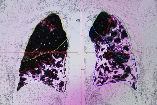 巴黎一家诊所的核磁共振（MRI）扫描显示了COVID-19如何损害患者的肺部。来源：Nathan Laine/Bloomberg/Getty