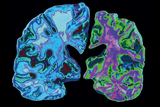 图中右侧大脑的神经元因为阿尔茨海默症而遭到破坏。|图源：Jessica Wilson/Science Photo Library
