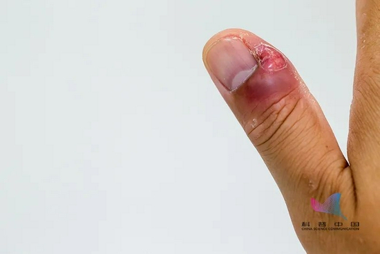 疼疼疼,倒刺撕到停不下来!真不是缺维生素,而是因为这个习惯