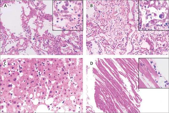 患者的右肺组织（A）、左肺组织（B）、肝组织（C）和心脏组织（D）的病理特征