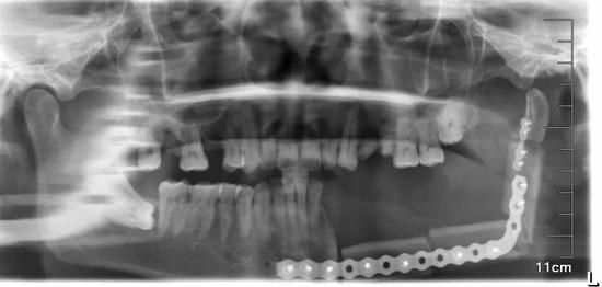 口腔癌术后的X光片