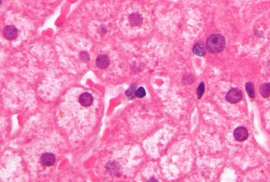 慢性乙型肝炎肝活检中可见玻璃状肝细胞
