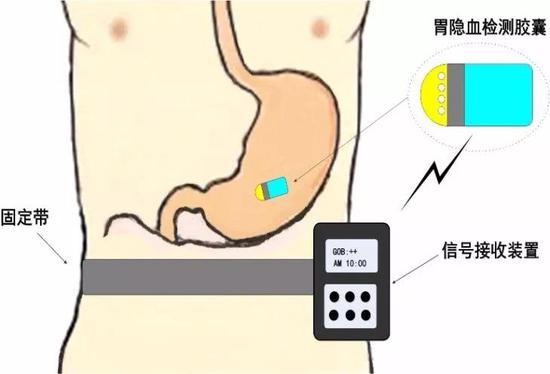 在胃部隐血检测过程中，患者在腰部带一个信号接收装置，通过吞服的胶囊内窥镜把胃部的隐血情况通过无线通讯的方式发送至体外。