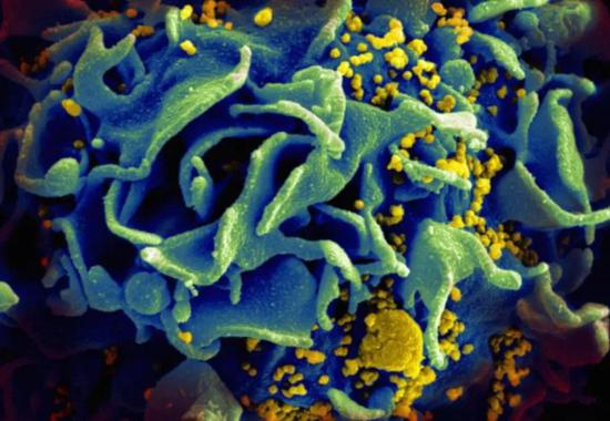▲HIV感染CD4阳性T细胞（图片来源：NIAID）