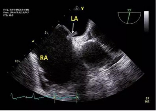 曹操为什么总是头痛？（不是高血压）