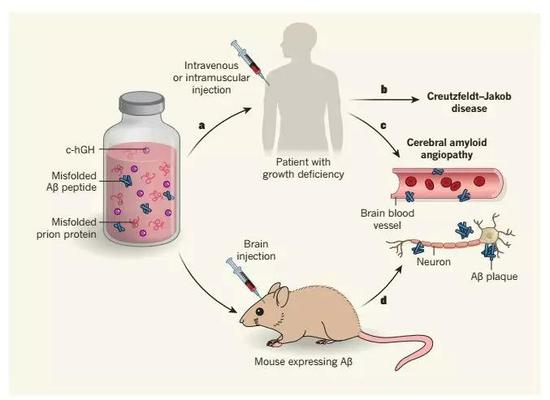▲尸源性人类生长激素，会引起人类的脑病（图片来源：参考资料[1]）