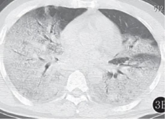  ▲SARS患者的“白肺”（图片来自网络）