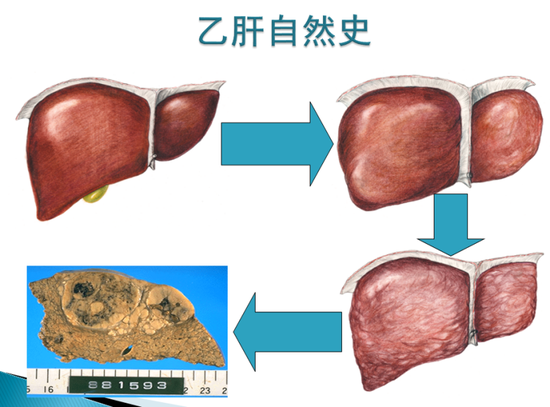 乙肝发展到肝癌的过程