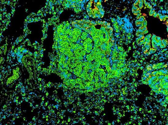 肺内早期肿瘤细胞（亮绿色）。由于他们获得了相对于比正常细胞更具优势的特性，从而能够快速生长。