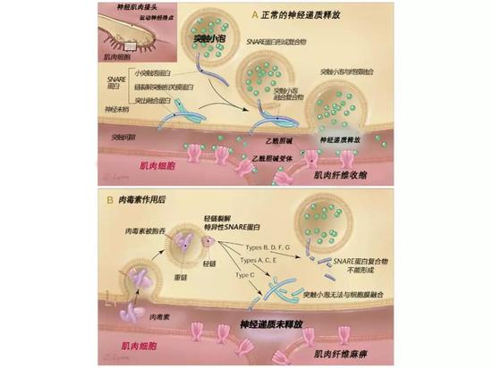 Mechanism of Action of Botulinum Toxin （Arnon et al。， 2001）