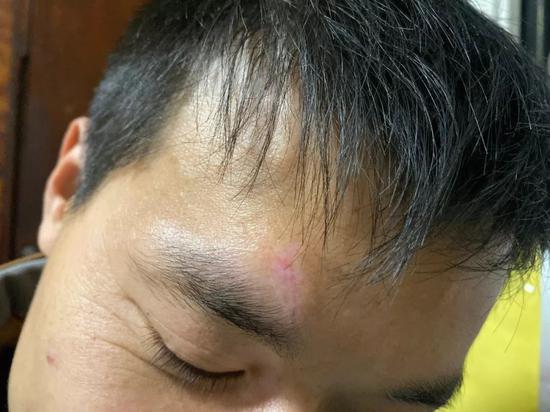 刘海科眼睛上方的伤口。新京报记者 祖一飞摄