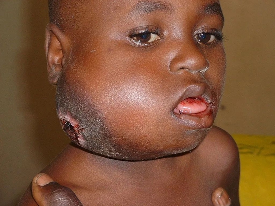 一名七岁的伯基特淋巴瘤患儿。图片来源：Mike Blyth，CC BY-SA 2.5
