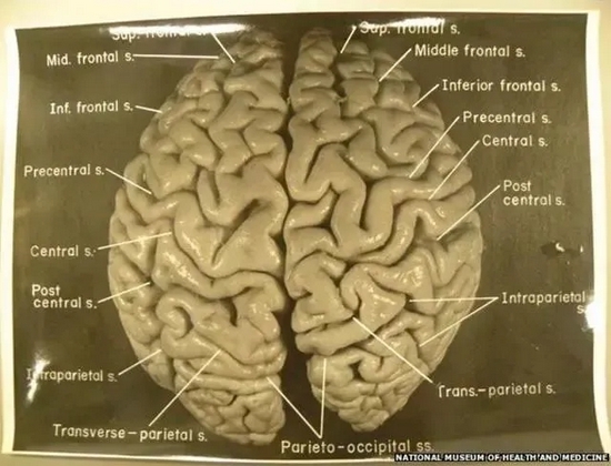 哈维当年拍摄的爱因斯坦大脑照片，现存于美国健康医药博物馆