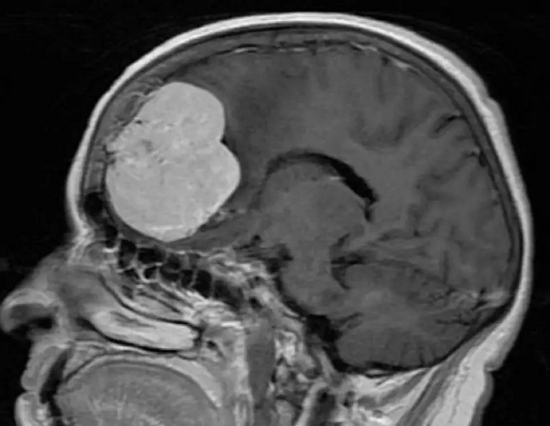 曹操为什么总是头痛？（不是高血压）