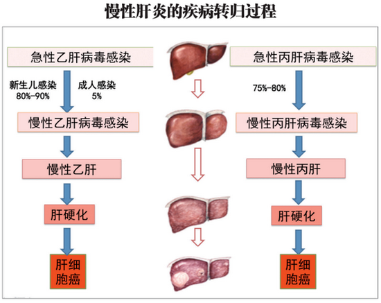 慢性肝炎的疾病转归过程