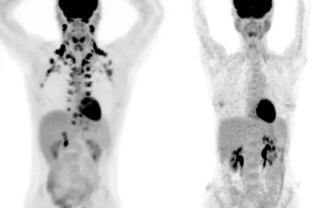 左图是颈部和锁骨部位有棕色脂肪的人，右图则没有（图片来源：MSKCC  Andreas G。 Wibmer & Heiko Schöder）