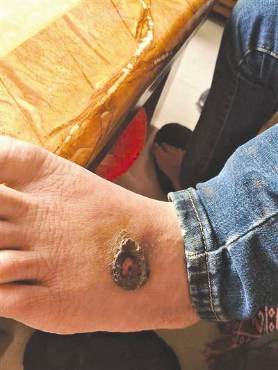 13岁少年离家在网吧打网游21天:双脚溃烂险截肢