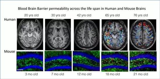 ▲MRI结果显示，人和小鼠的血脑屏障都会随着衰老而出现渗漏（图片来源：参考资料[3]）